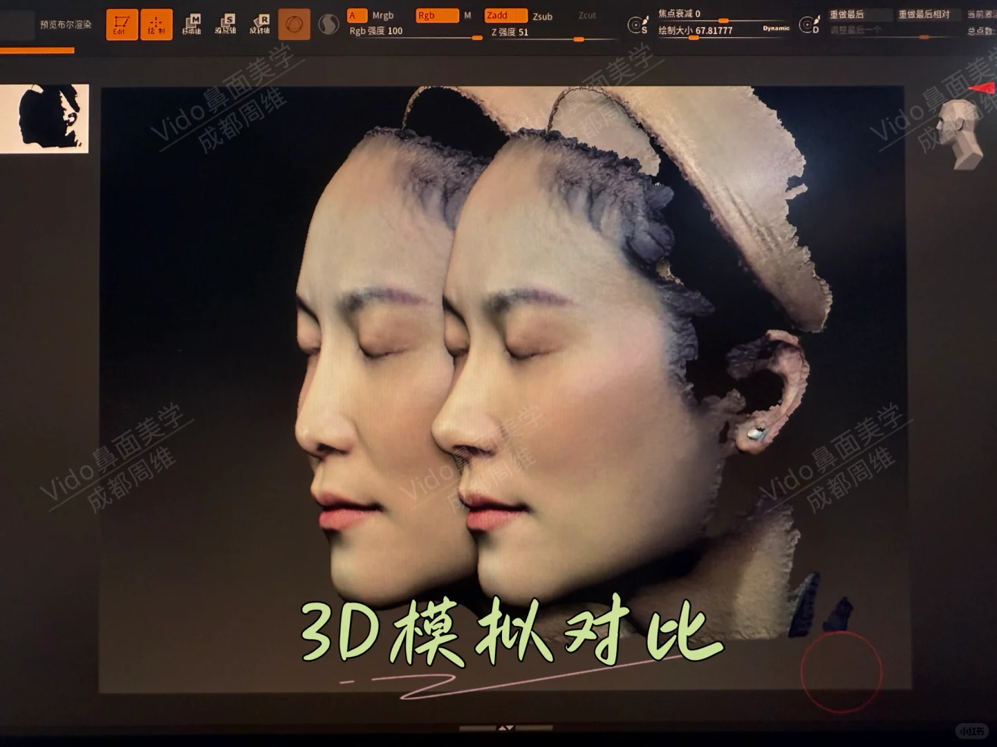直鼻微翘，3D模拟对比