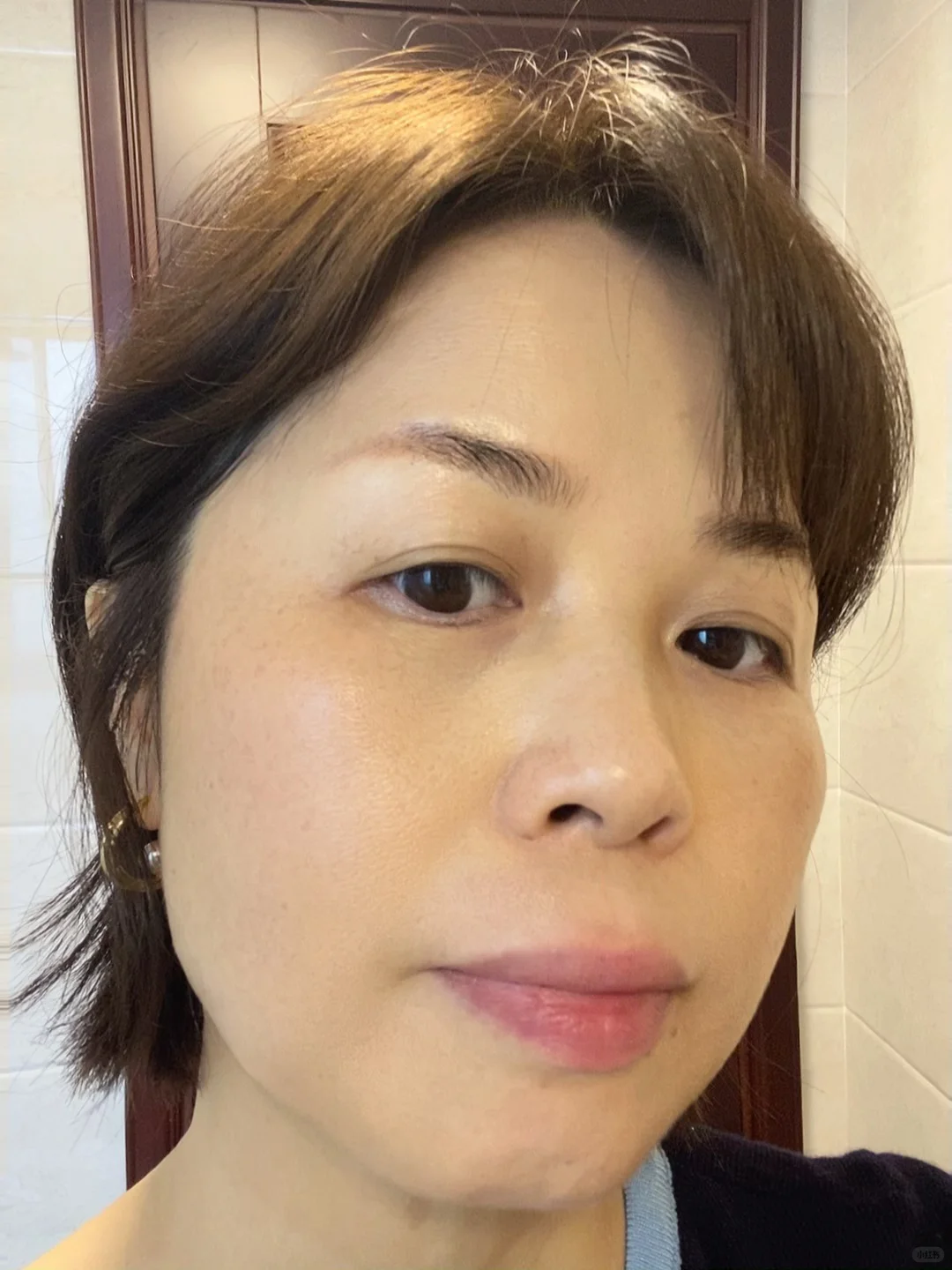 炎症排出来了！我真的没整容！