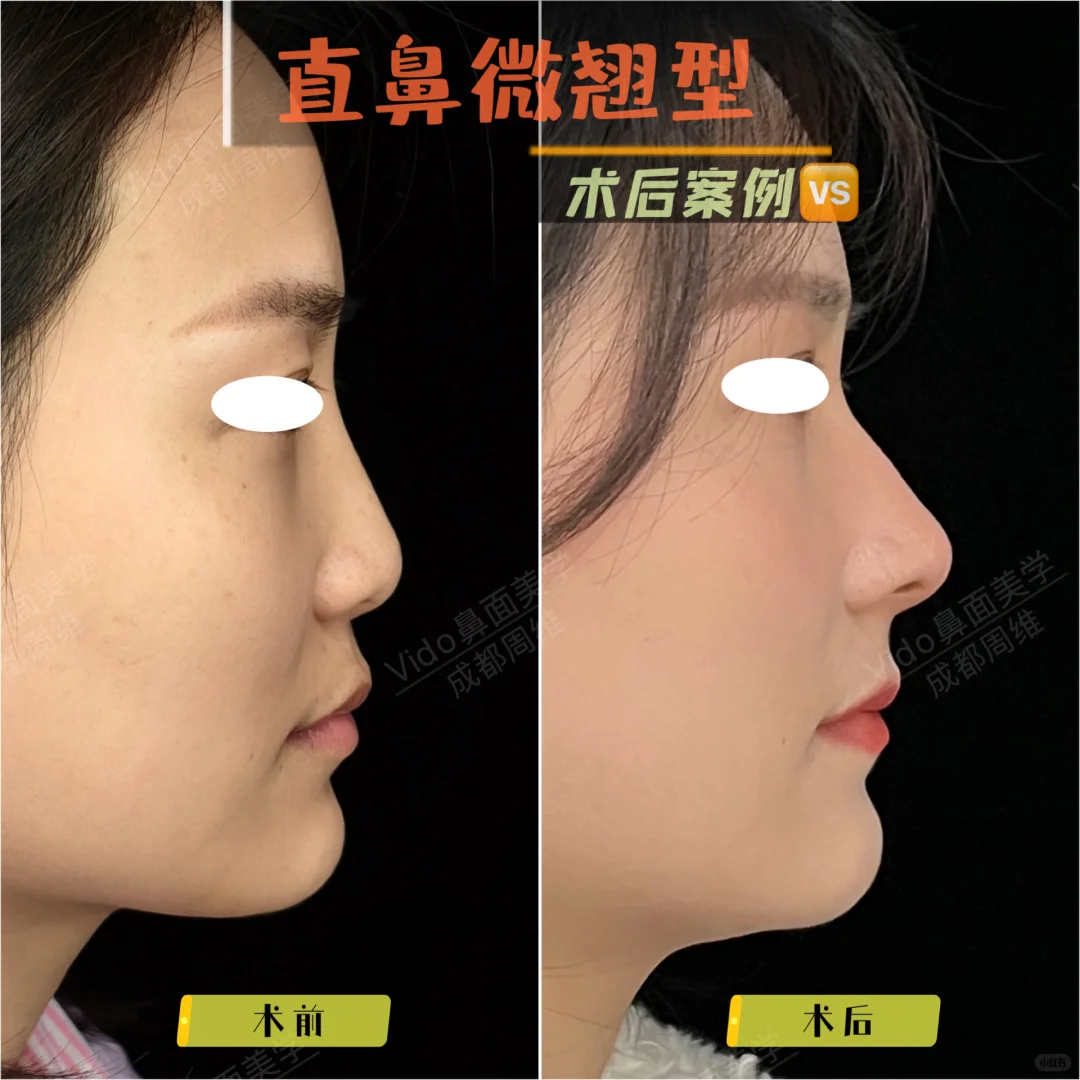 直鼻微翘，3D模拟对比