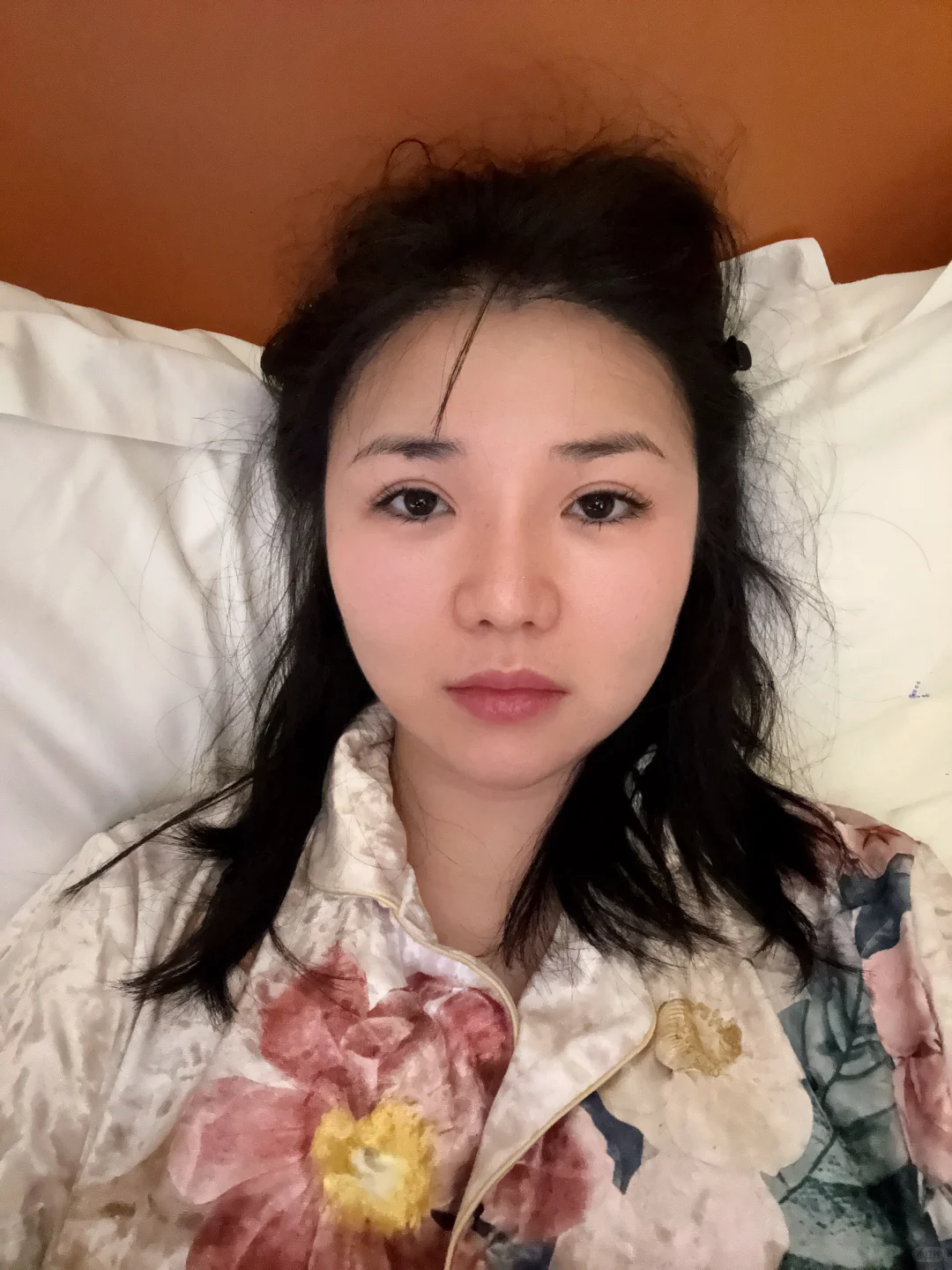 来长沙做鼻子了 手术完成后续