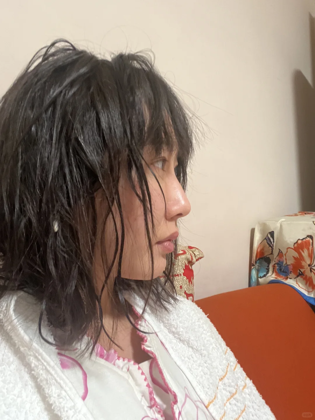 眼综合Day94+注射隆鼻/卧蚕Day50