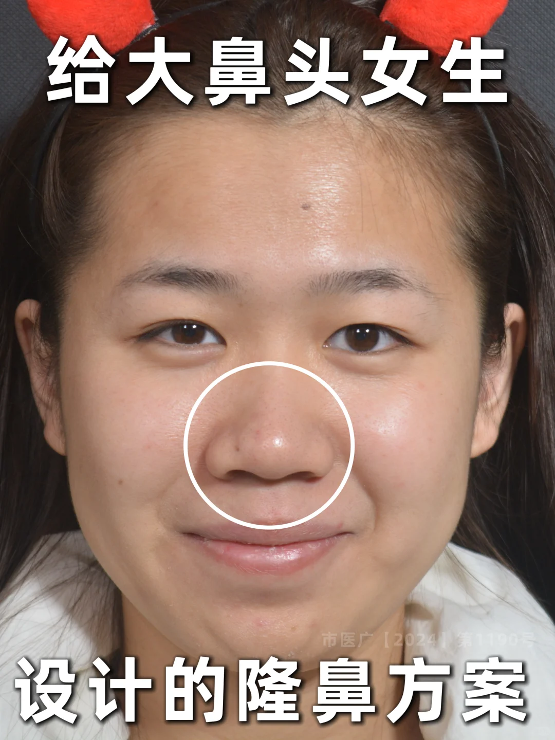 给大鼻头女生设计的👃隆鼻方案！