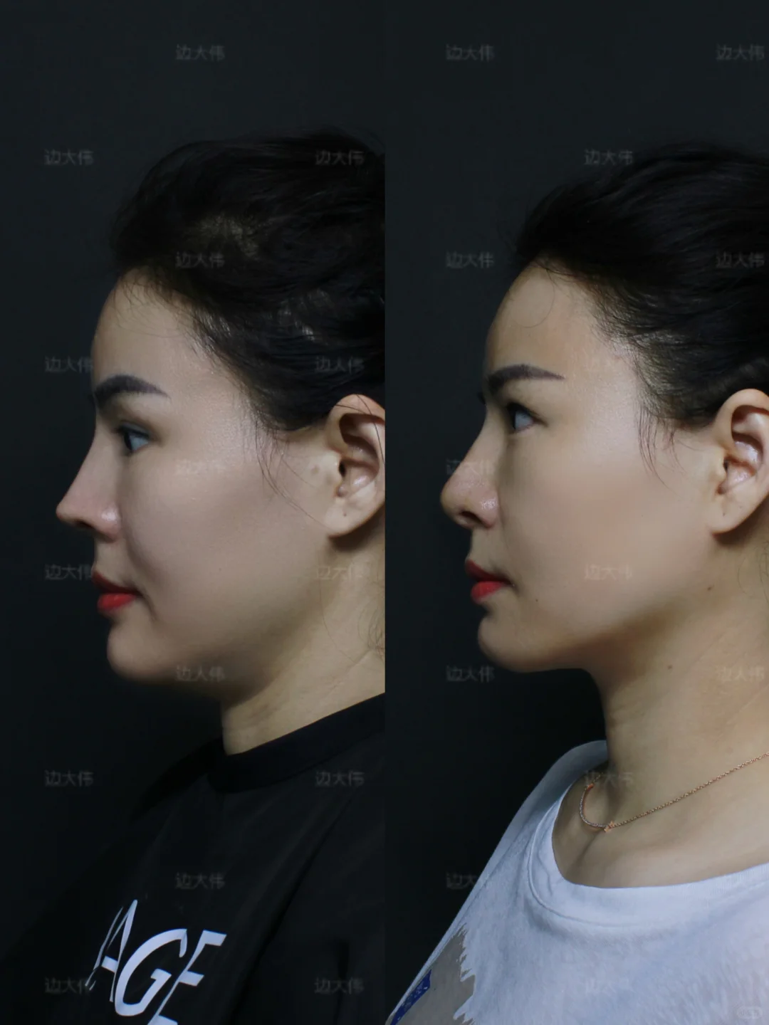 鼻修复｜原图直出📸通天鼻爆改自然妈生鼻