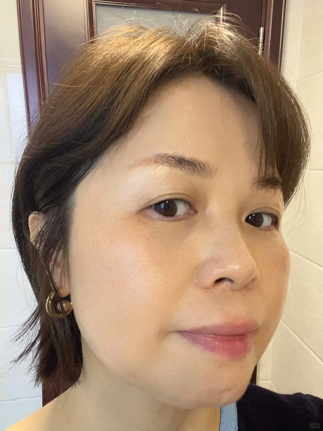 炎症排出来了！我真的没整容！