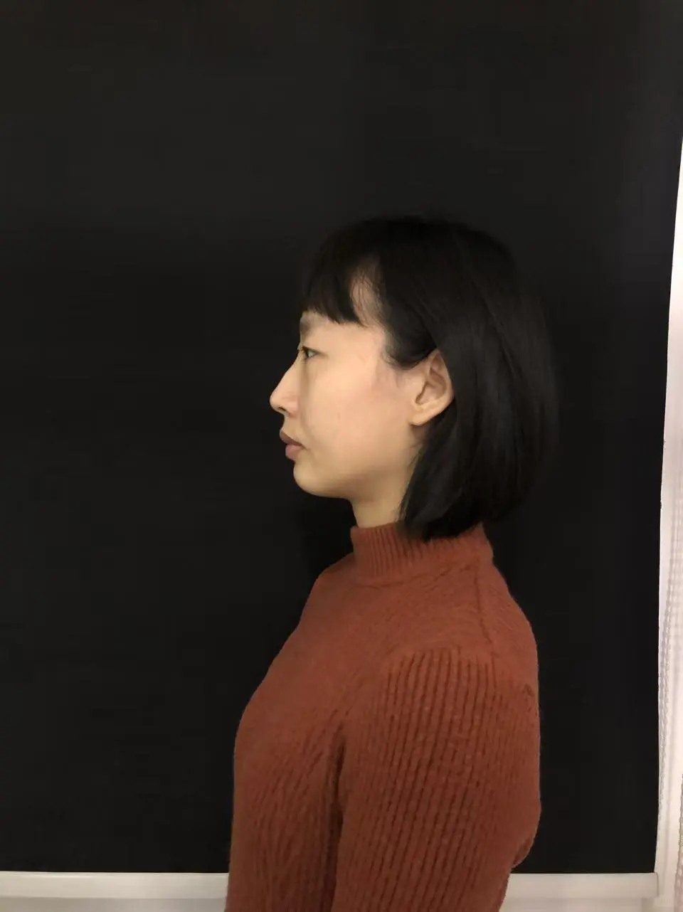 眼综合Day94+注射隆鼻/卧蚕Day50