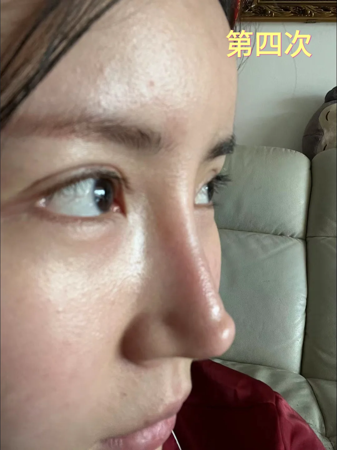 整形15年，我竟成了鼻修复“专业户”