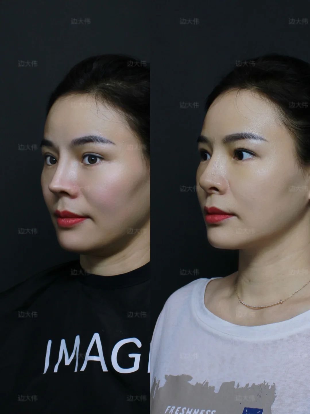 鼻修复｜原图直出📸通天鼻爆改自然妈生鼻