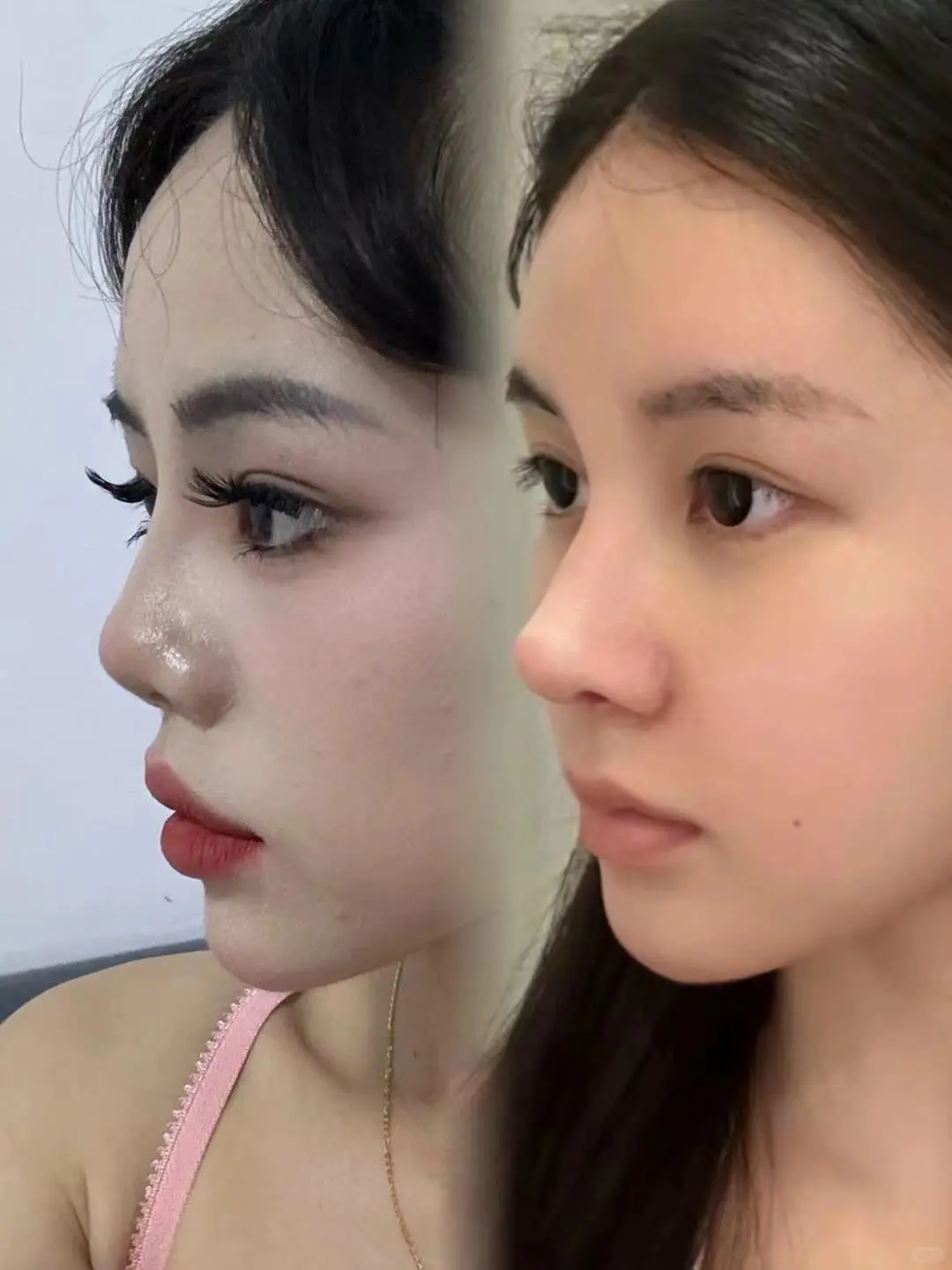 没有对比就没有伤害,妈生鼻V再生鼻