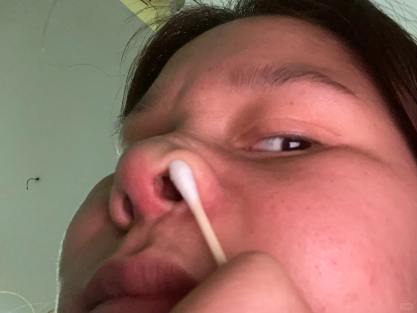 隆鼻后鼻小柱内侧鼓包