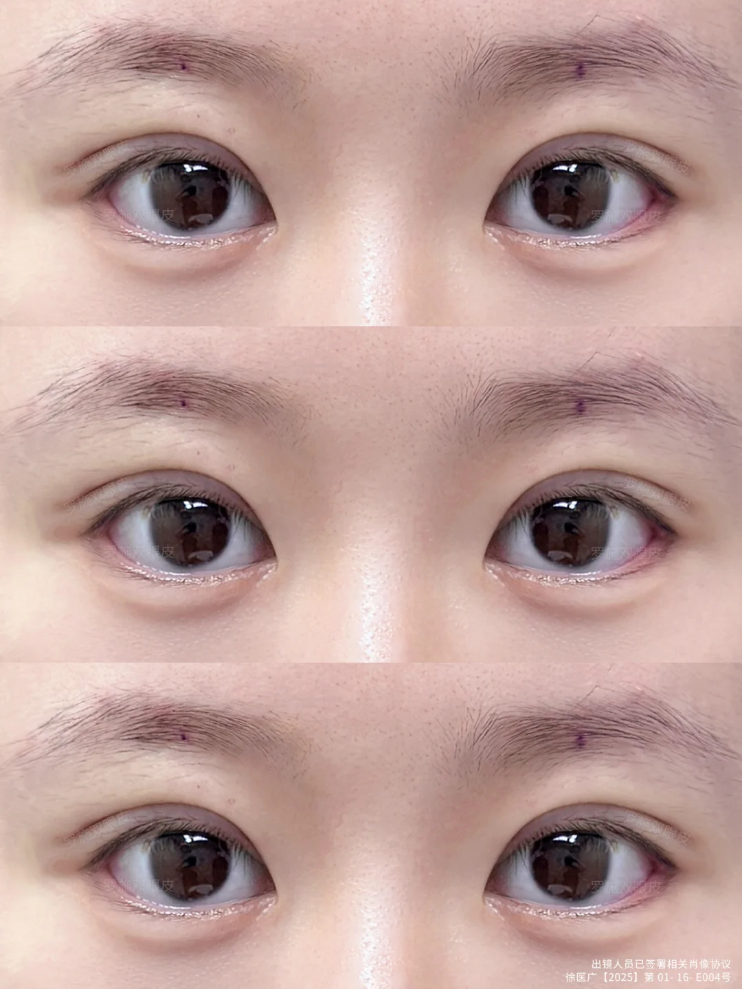 上海双眼皮｜7.5mm平扇➕幼态卧蚕～真的绝了😭