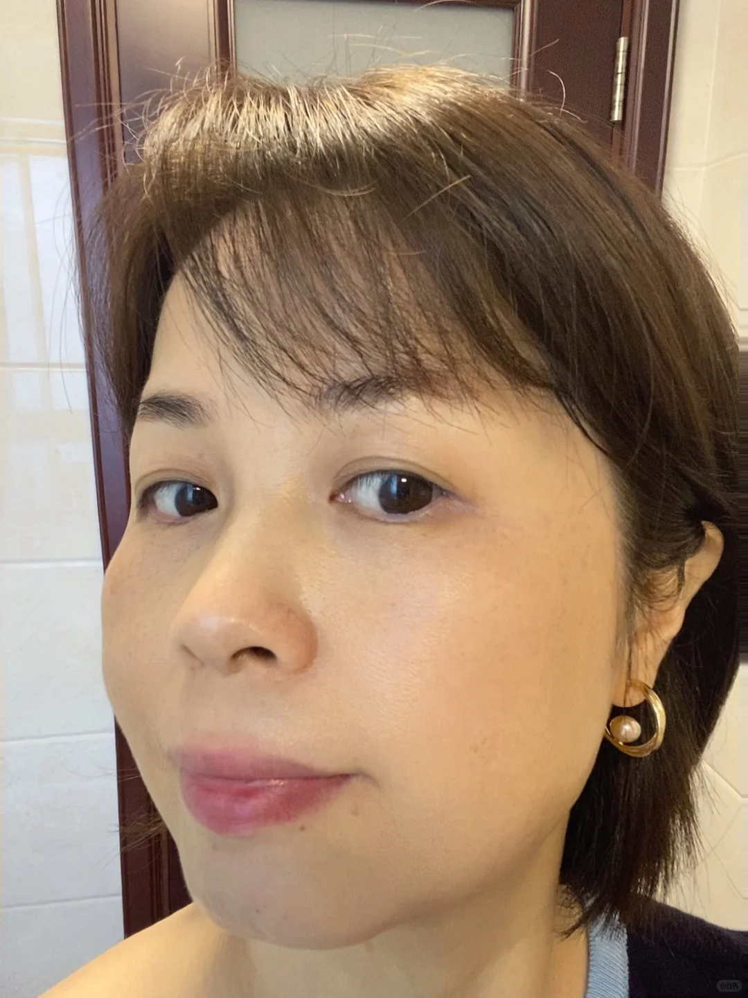 炎症排出来了！我真的没整容！