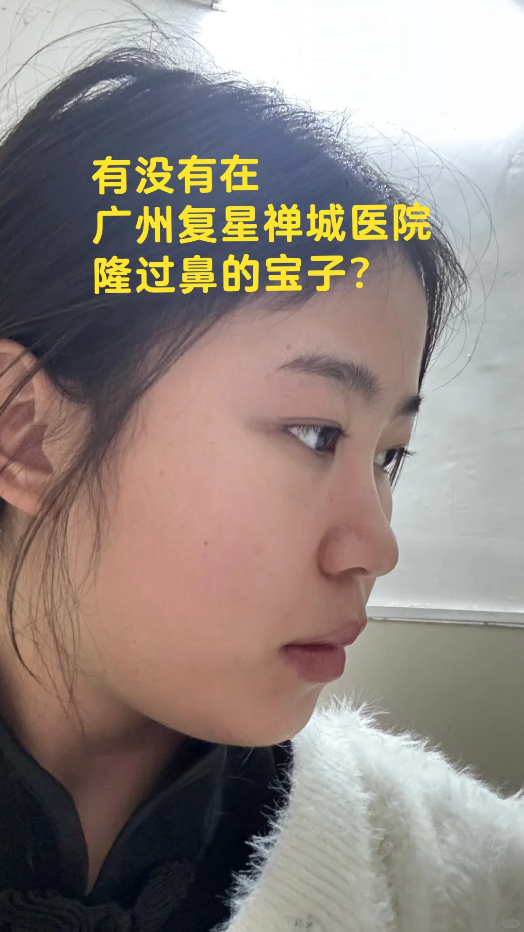 有没有在广州新市复星禅城隆鼻的姐妹？