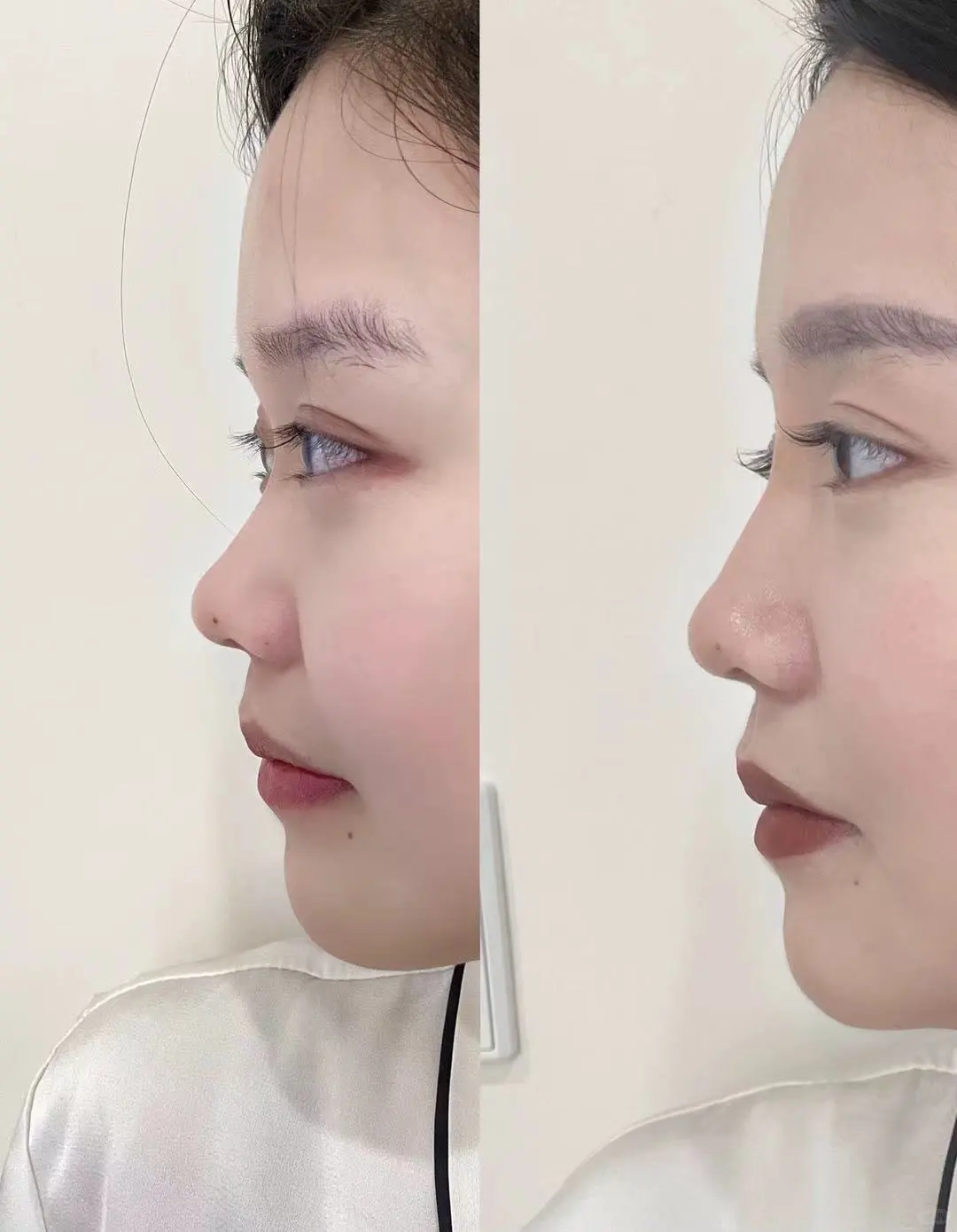 没有对比就没有伤害,妈生鼻V再生鼻