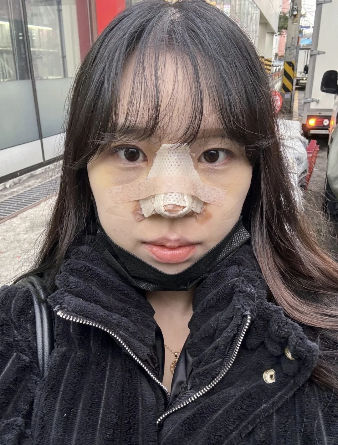 年假在重庆do了个鼻子