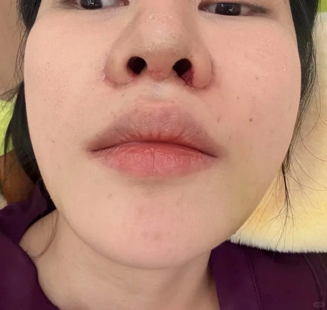别再去做缩鼻翼了谁做谁后悔