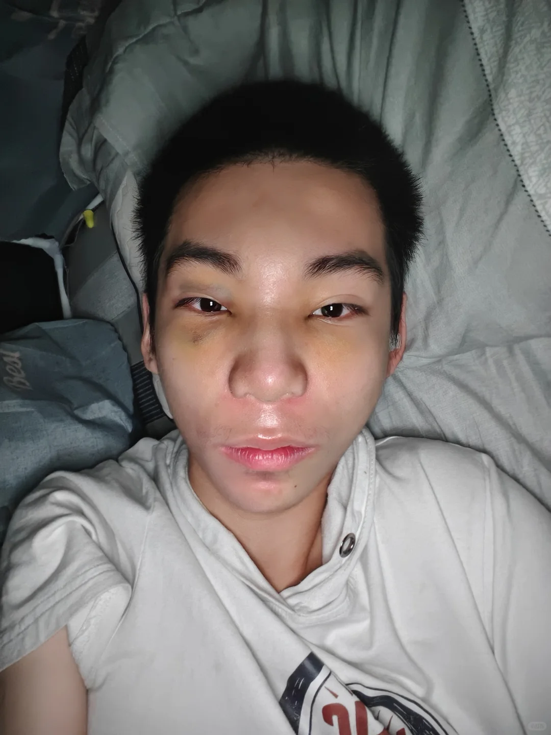 蹲的来看!do鼻9天脸和鼻子都消肿了很多啦