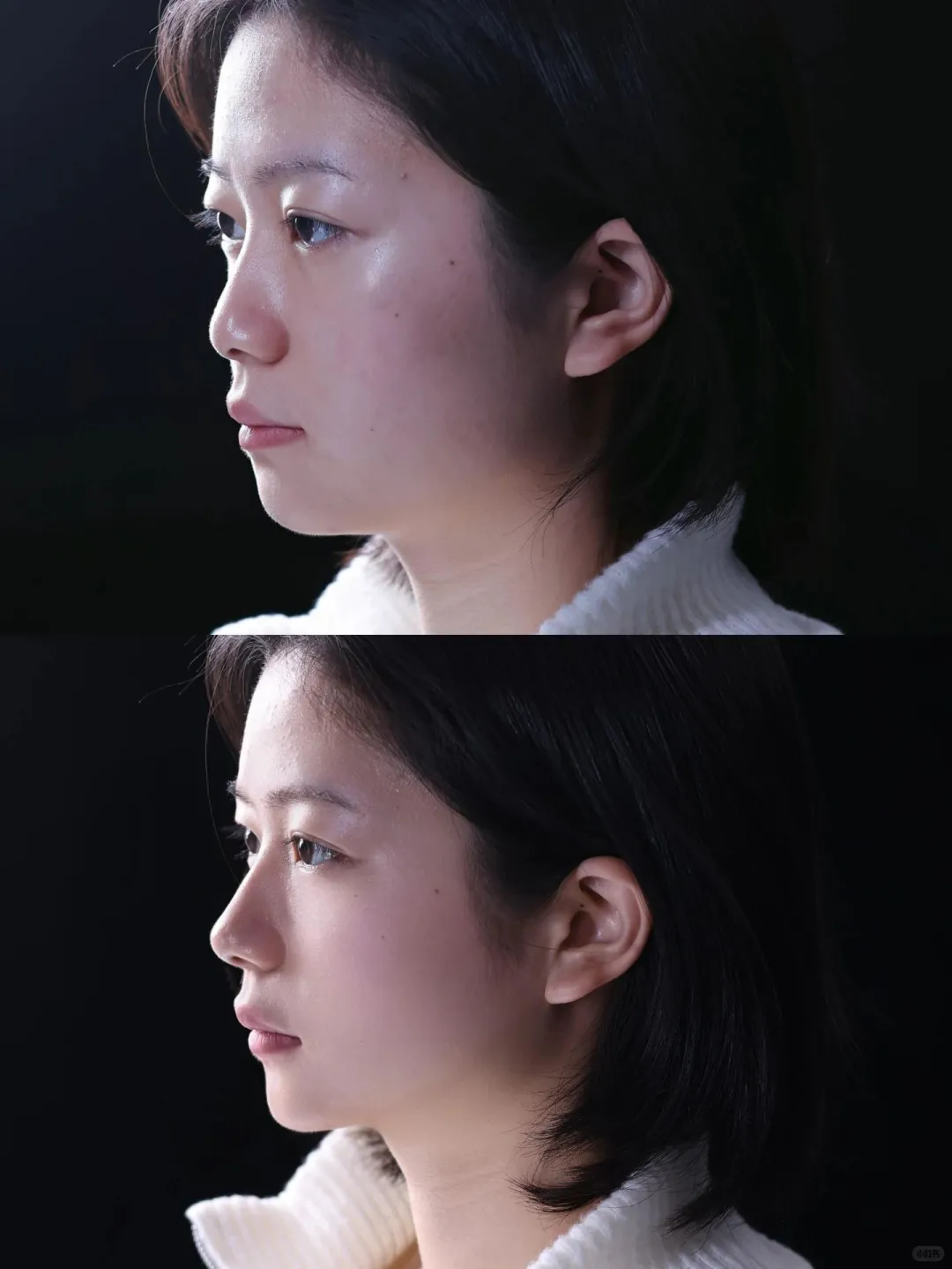 塌鼻子拜拜，轻松打造侧颜杀