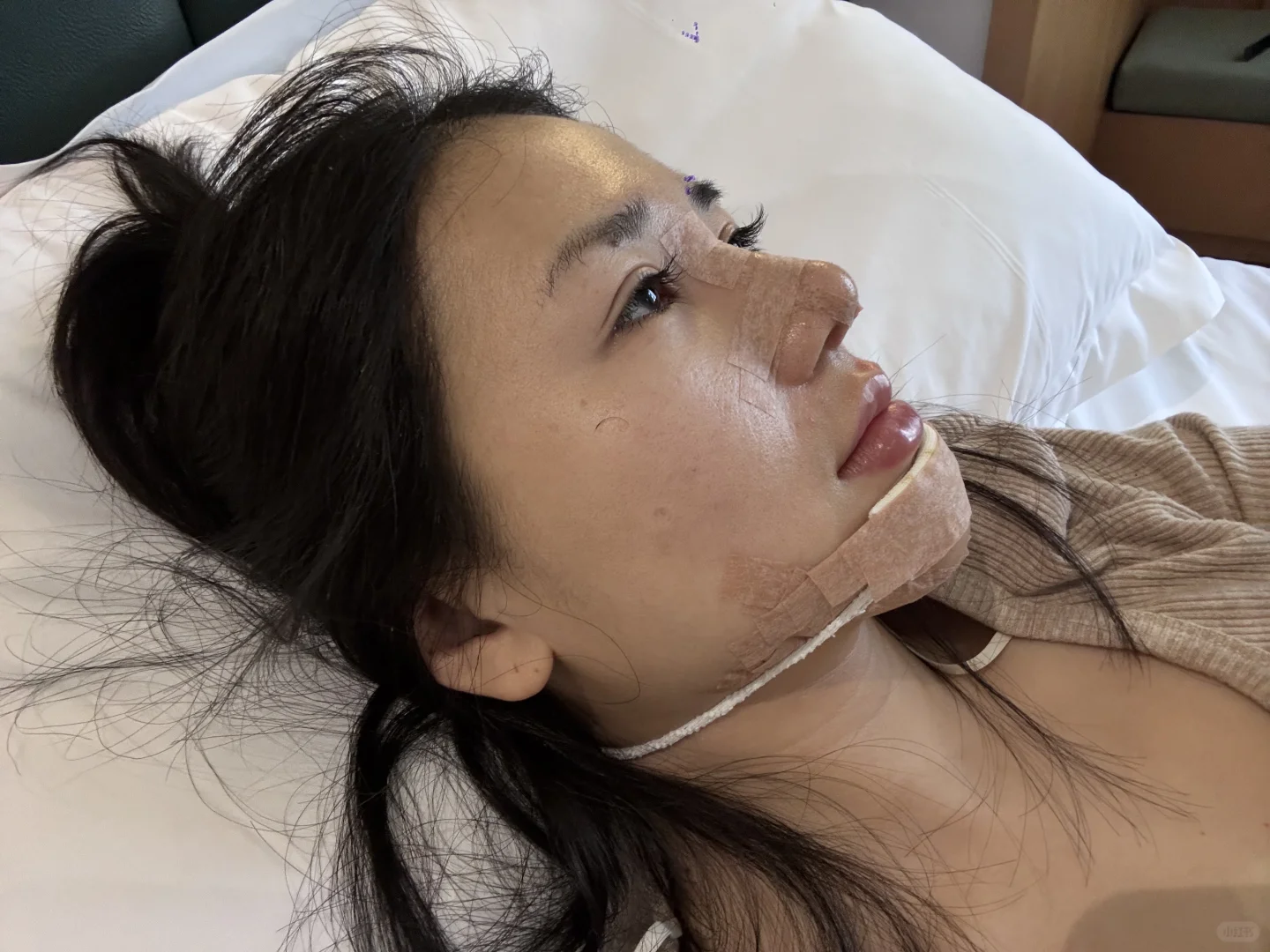 来长沙做鼻子了 手术完成后续