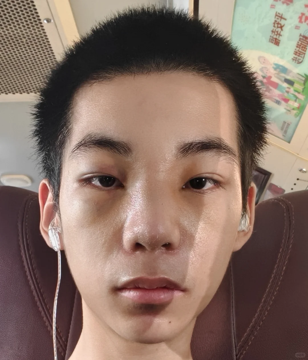 蹲的来看!do鼻9天脸和鼻子都消肿了很多啦