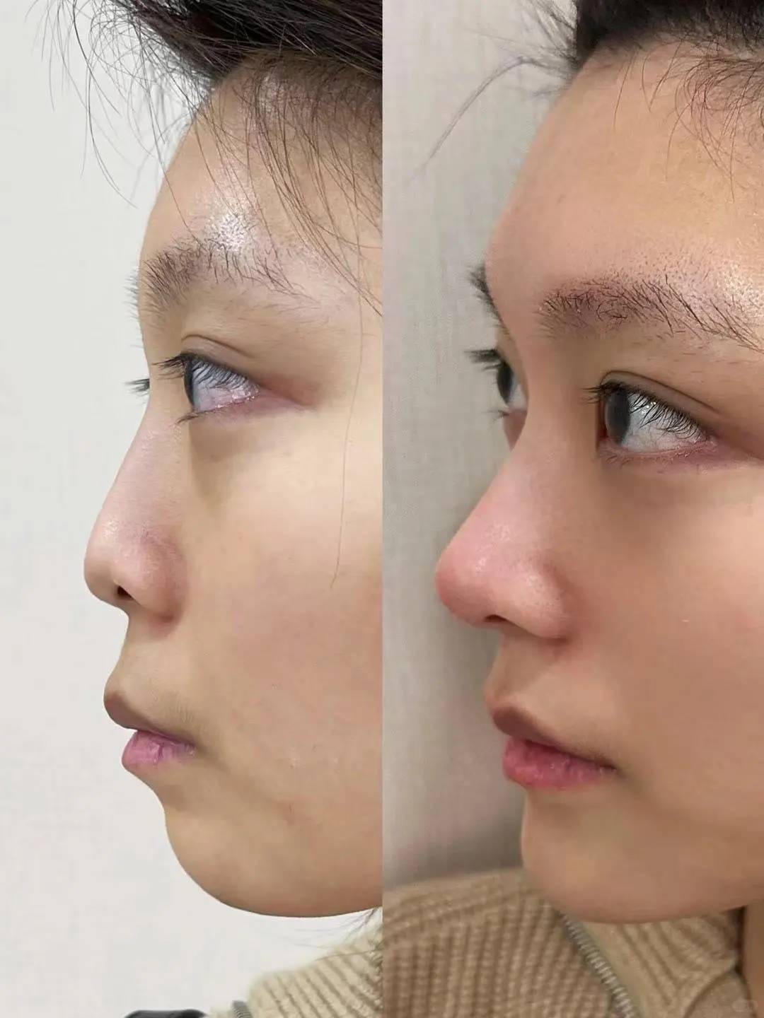 没有对比就没有伤害,妈生鼻V再生鼻