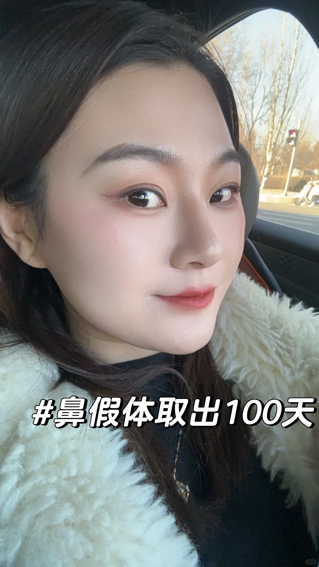 鼻假体取出100天啦