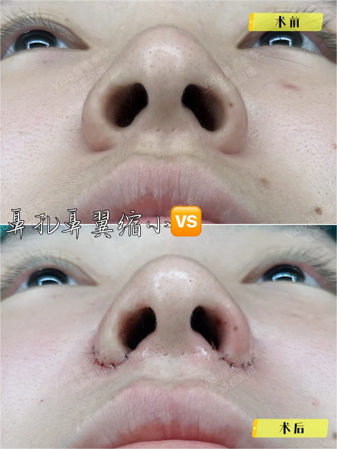 鼻孔鼻翼缩小🆚