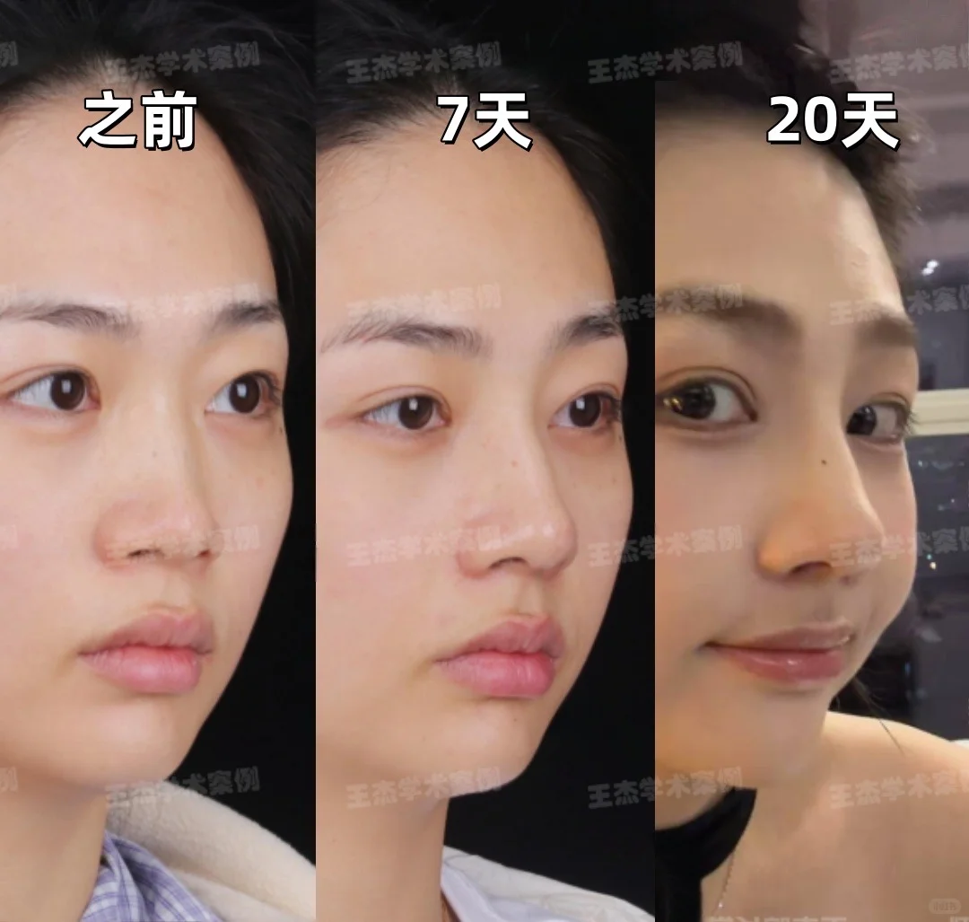 深圳do鼻|宽鼻+鼻基底凹陷