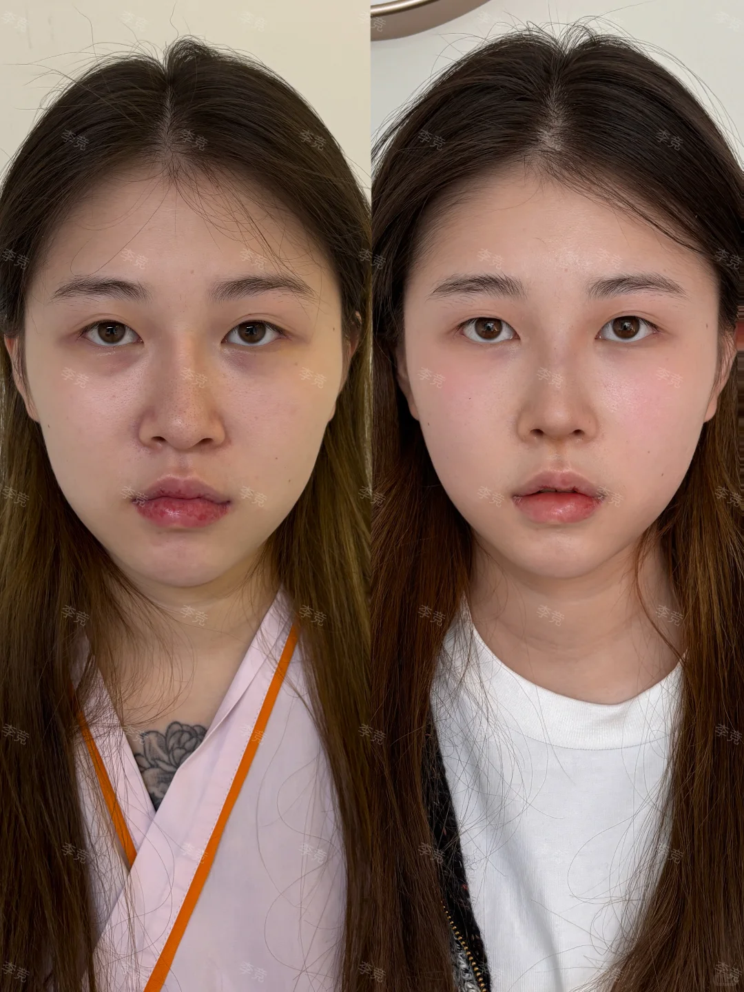 成都隆鼻圣手|纤铂塑造上镜骨感鼻