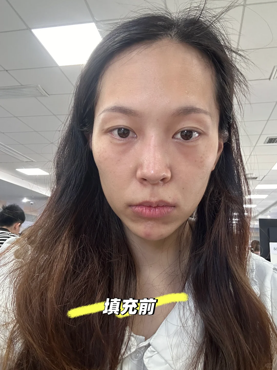 脂肪填充面部半个月