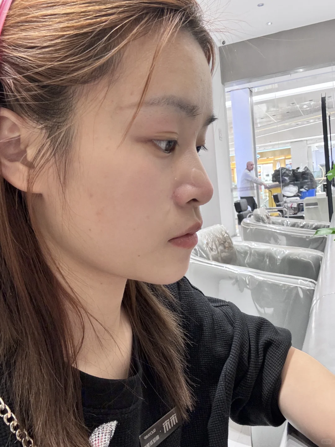 求助：隆鼻哪一种疤痕可以不明显