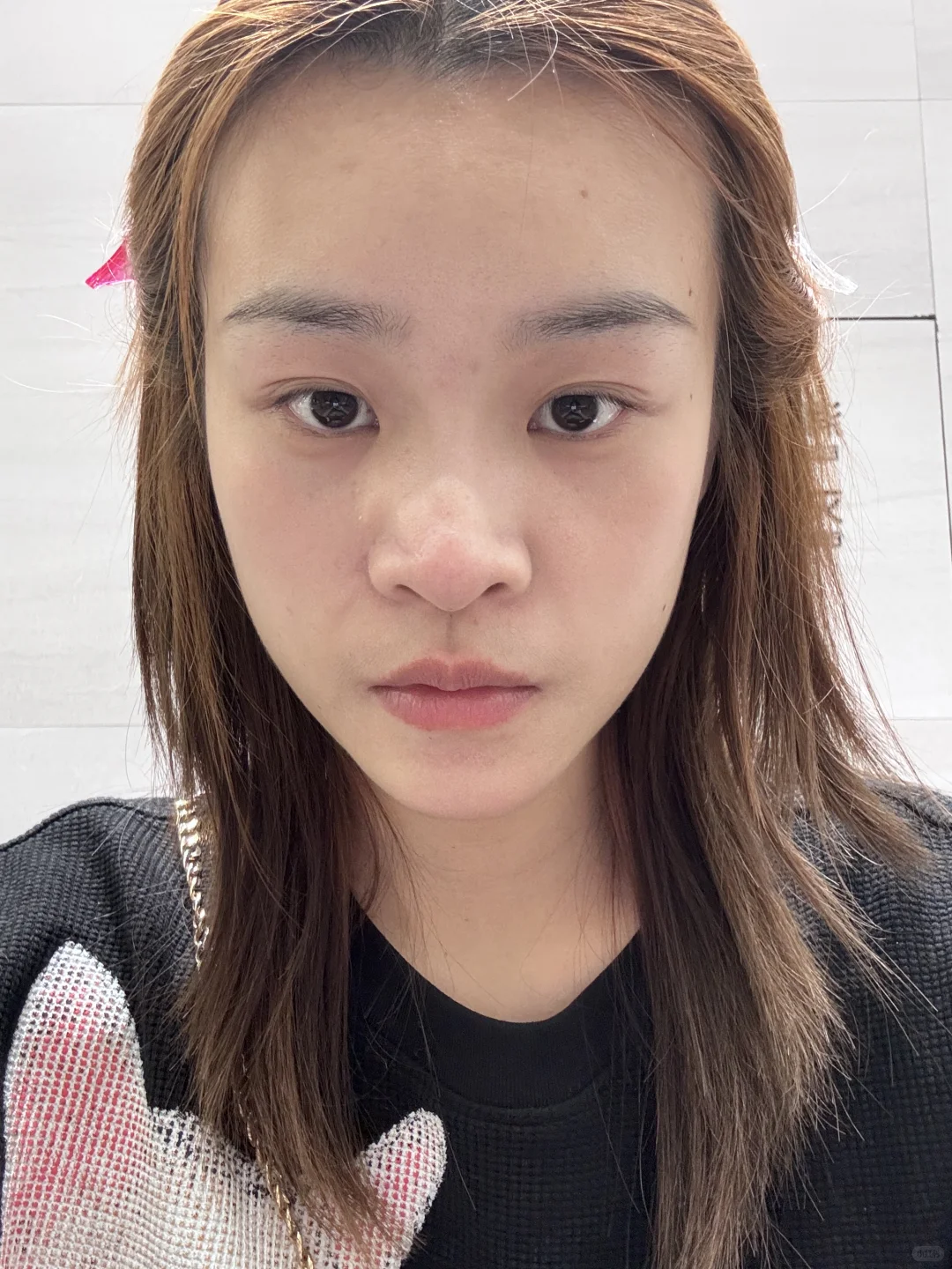 求助：隆鼻哪一种疤痕可以不明显