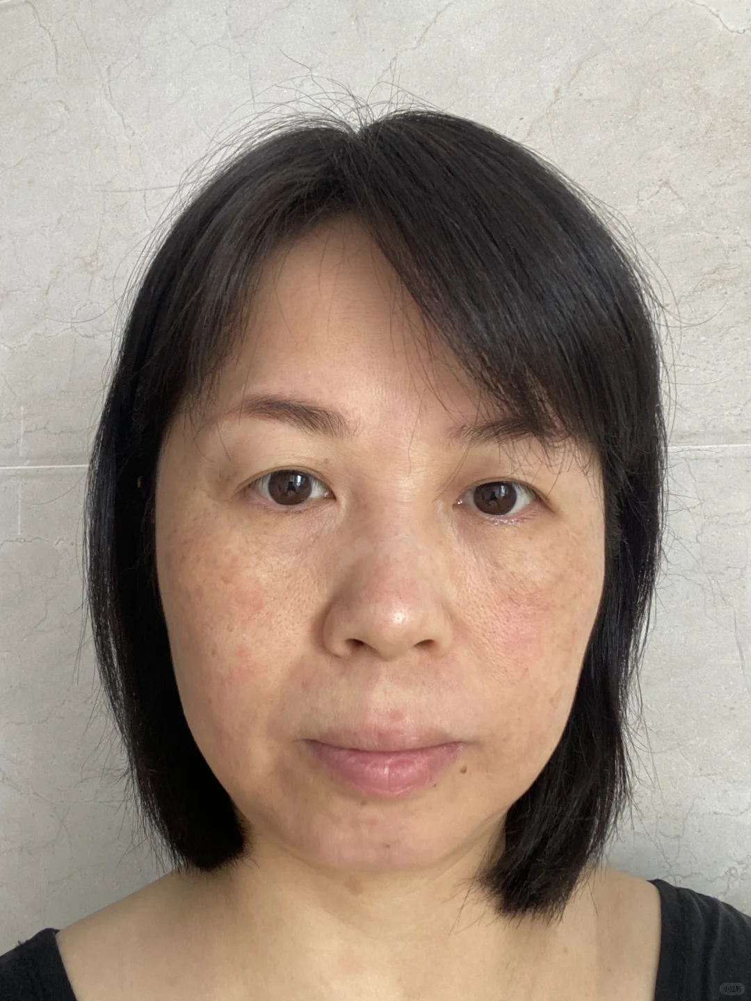 炎症排出来了！我真的没整容！