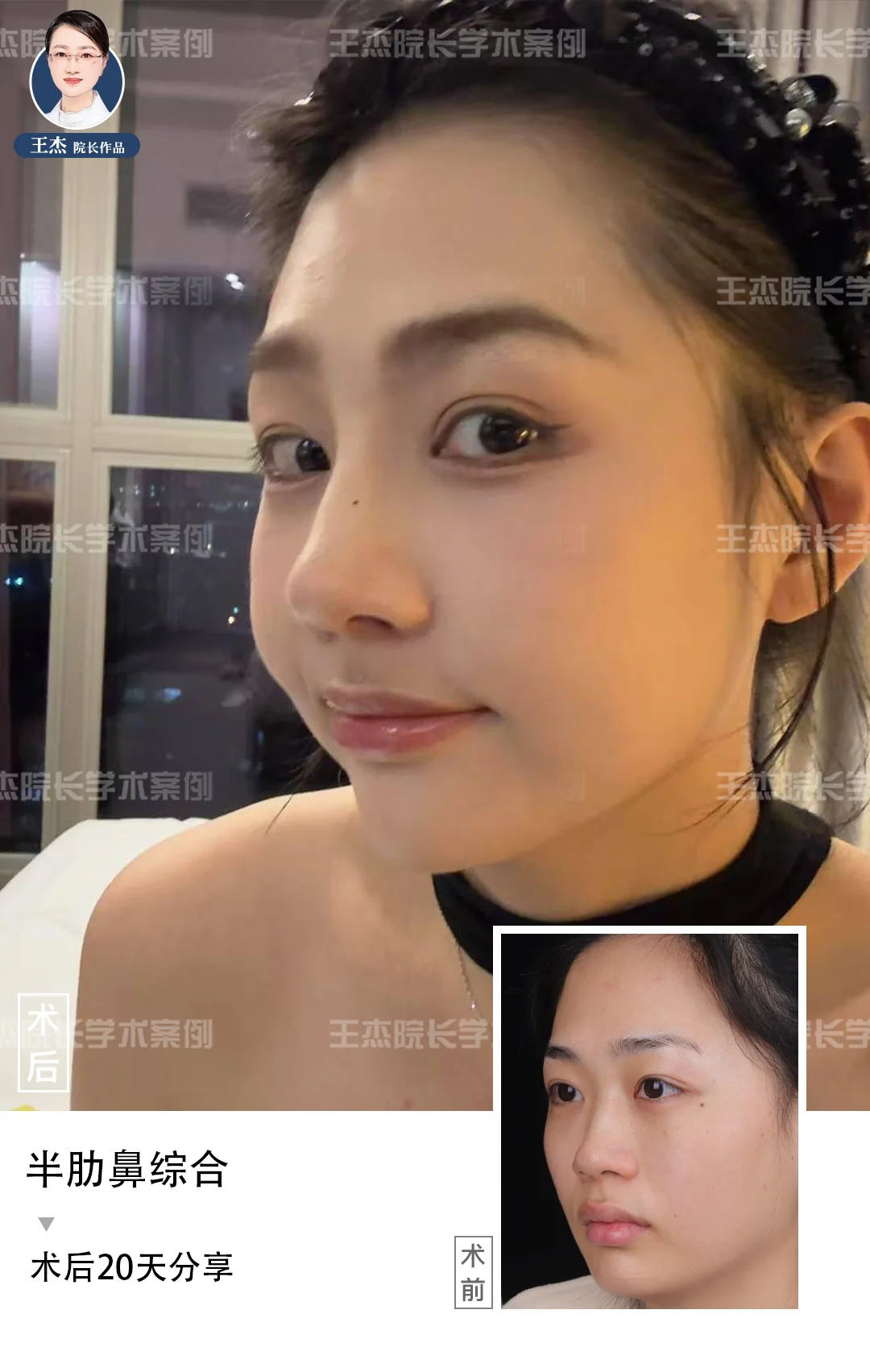 深圳do鼻|宽鼻+鼻基底凹陷