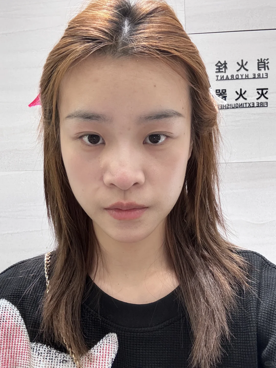 求助：隆鼻哪一种疤痕可以不明显