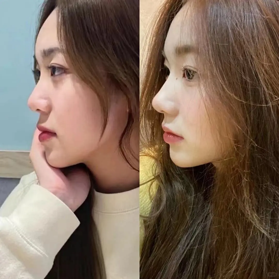 没有对比就没有伤害,妈生鼻V再生鼻