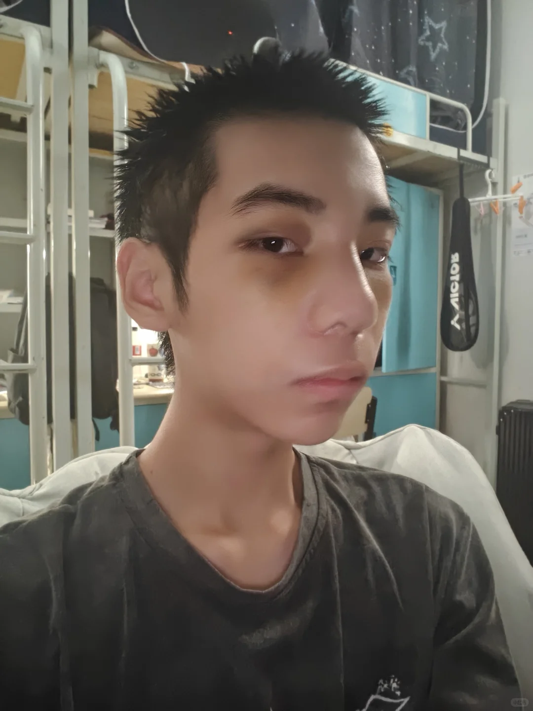 蹲的来看!do鼻9天脸和鼻子都消肿了很多啦