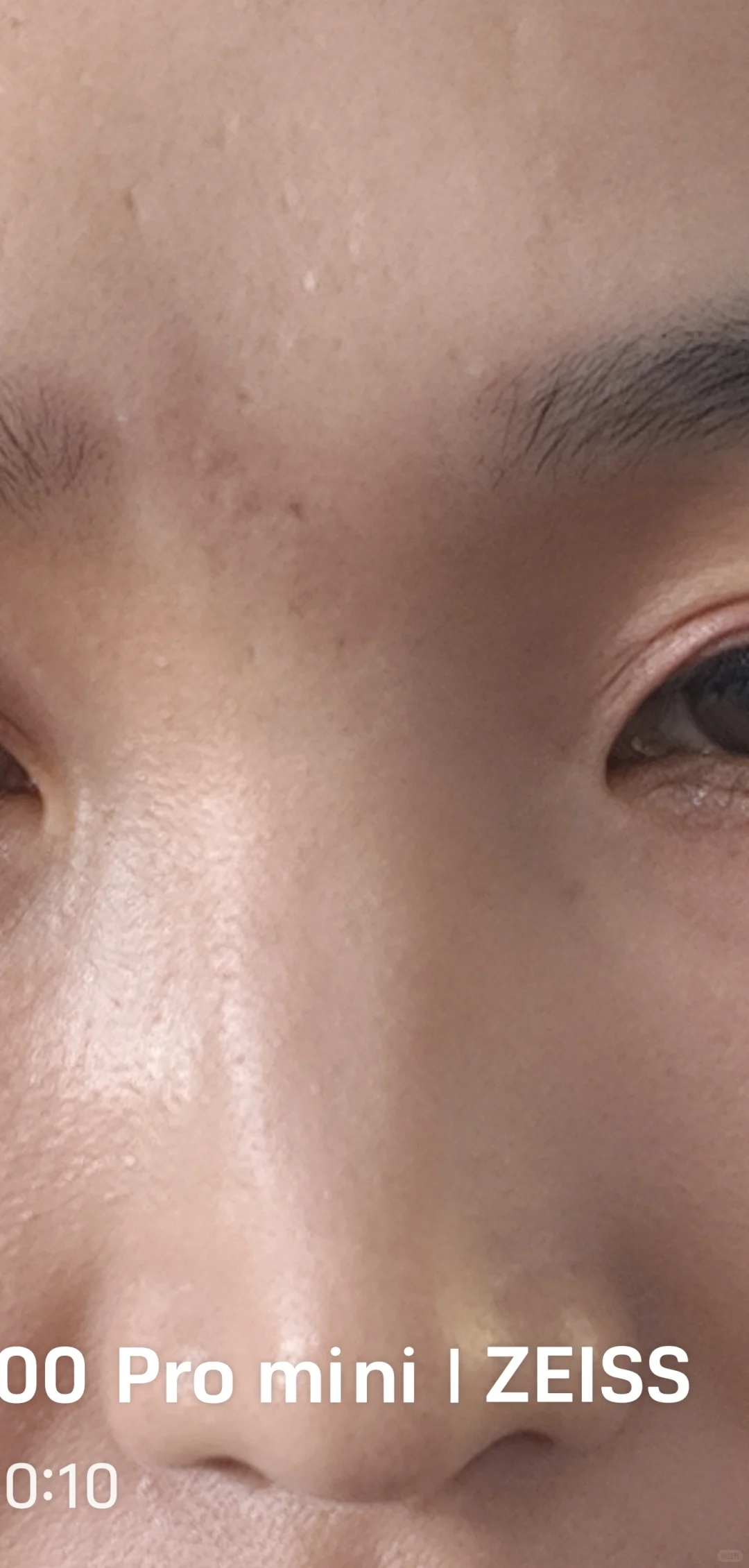 取硅胶假体鼻子7天了，鼻背中间凹陷