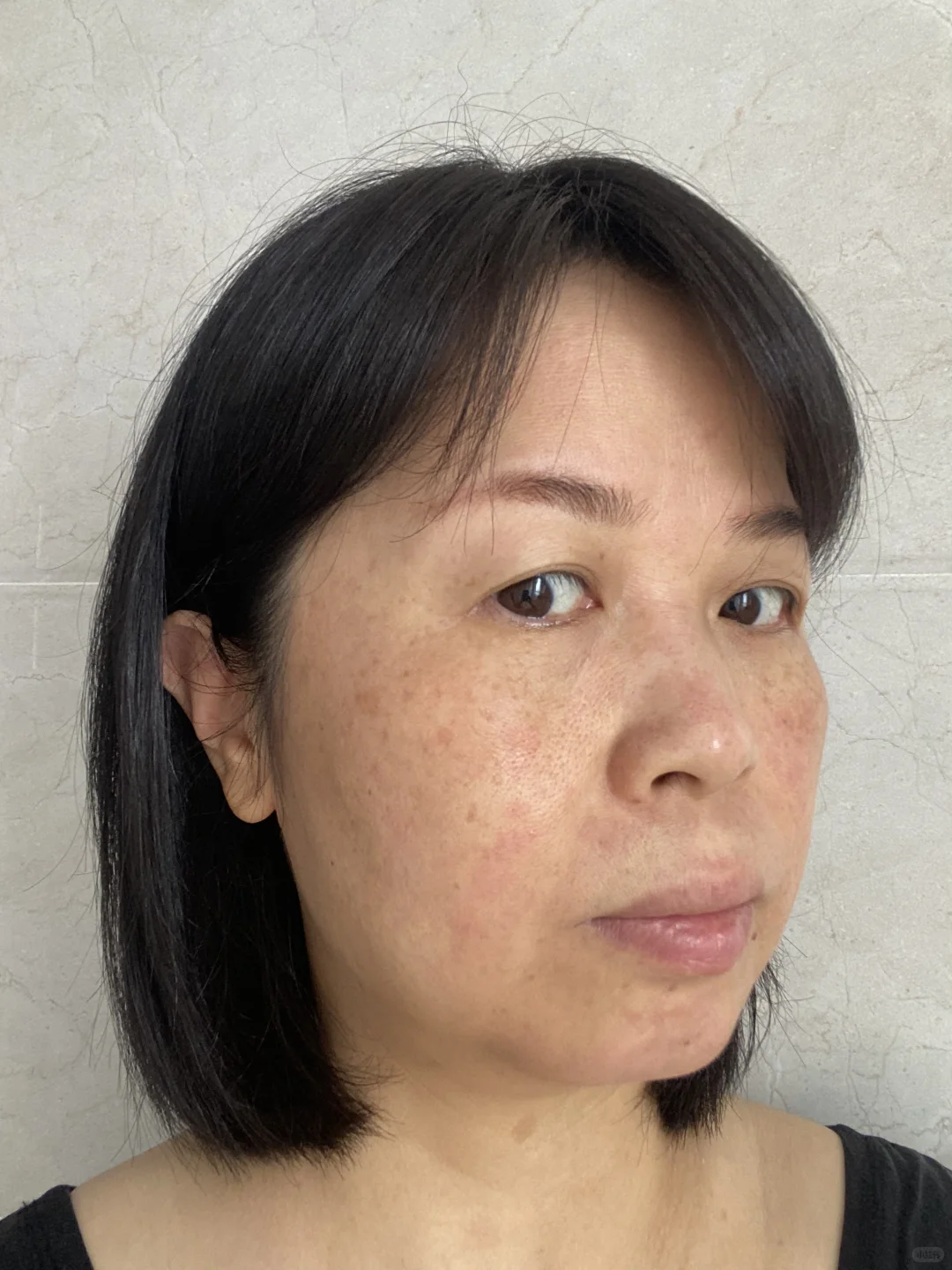 炎症排出来了！我真的没整容！