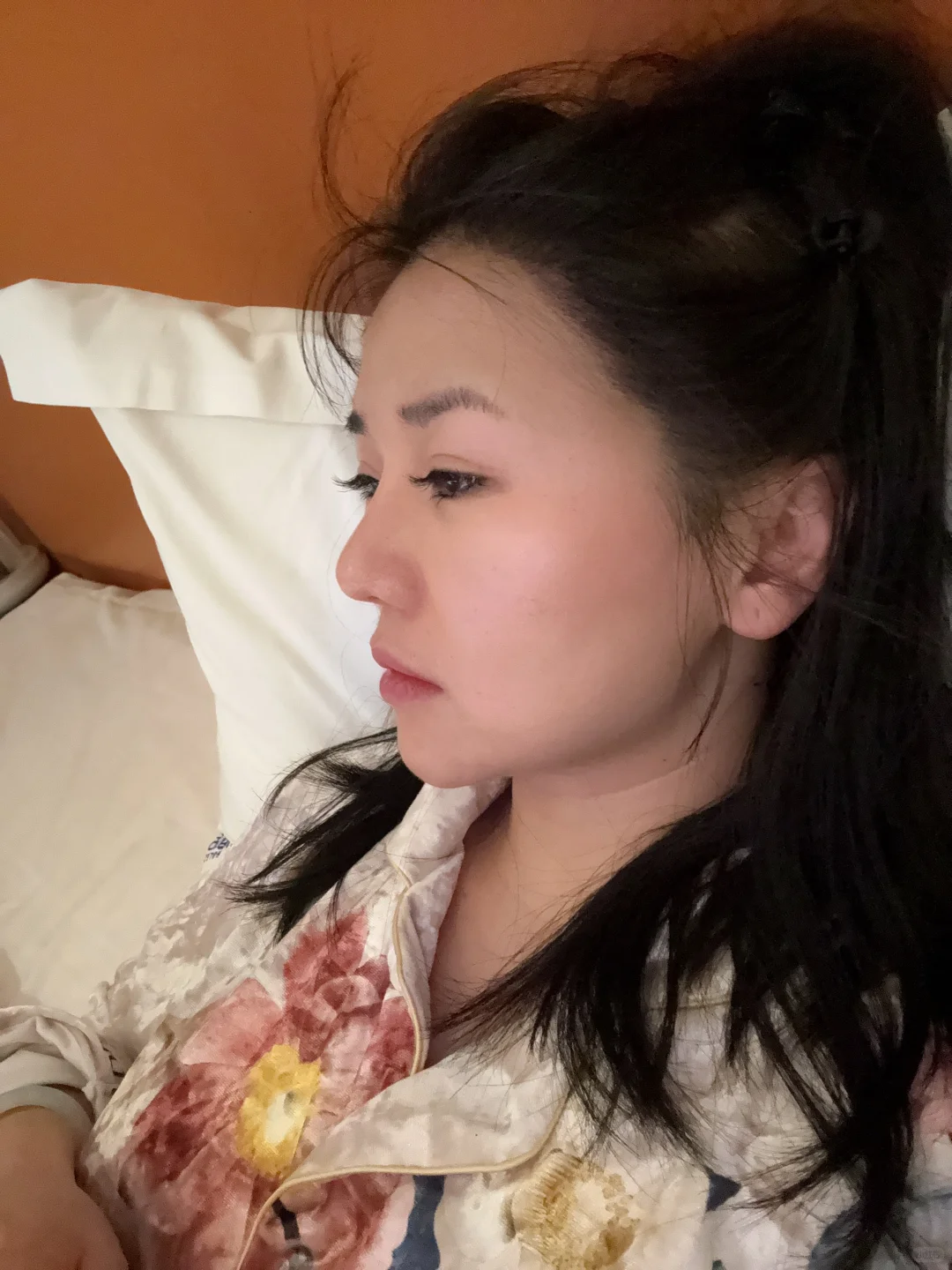 来长沙做鼻子了 手术完成后续