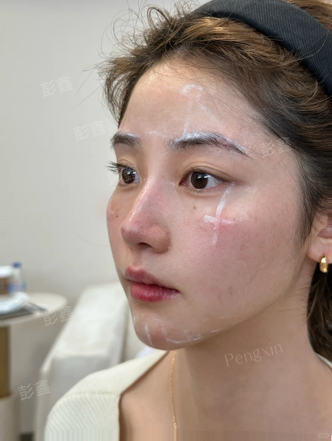 扁平脸＋垮脸凹陷，在上海全脸用了4只，变化也