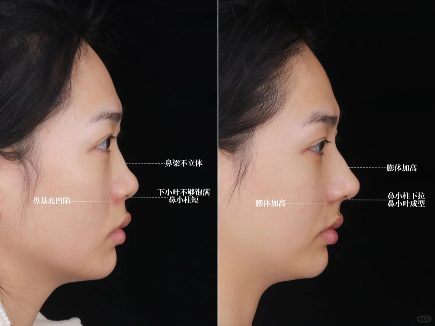 深圳do鼻|宽鼻+鼻基底凹陷