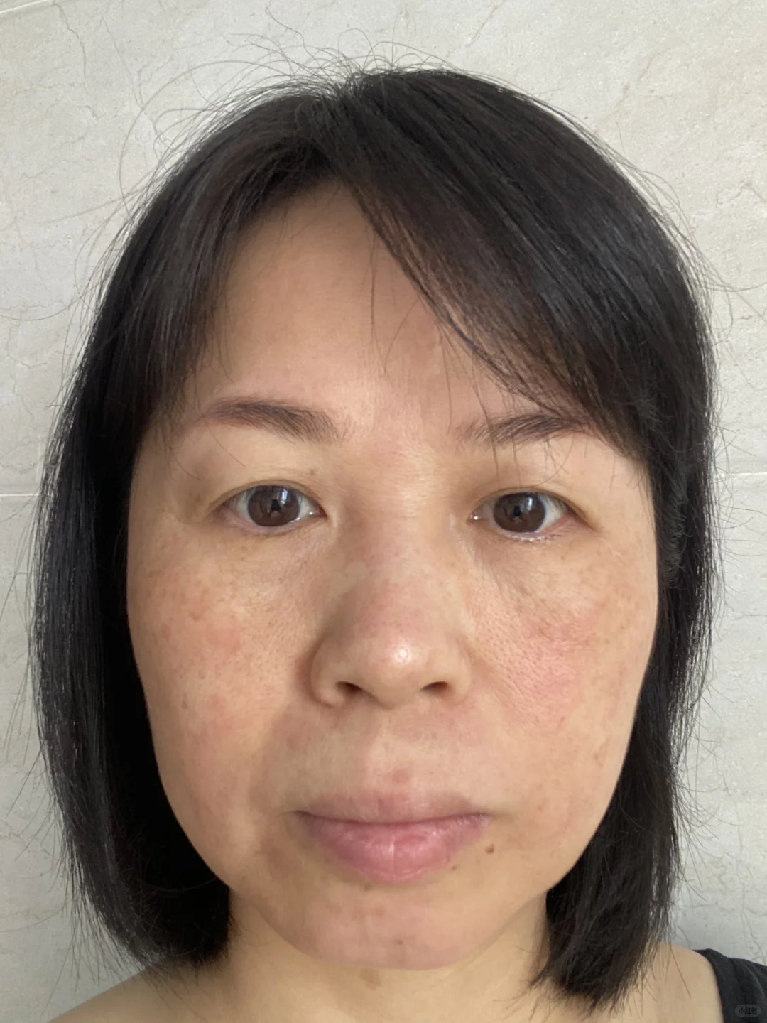 炎症排出来了！我真的没整容！