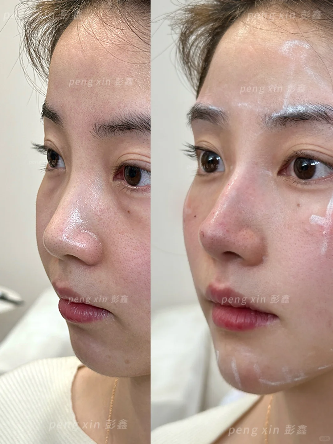 扁平脸＋垮脸凹陷，在上海全脸用了4只，变化也