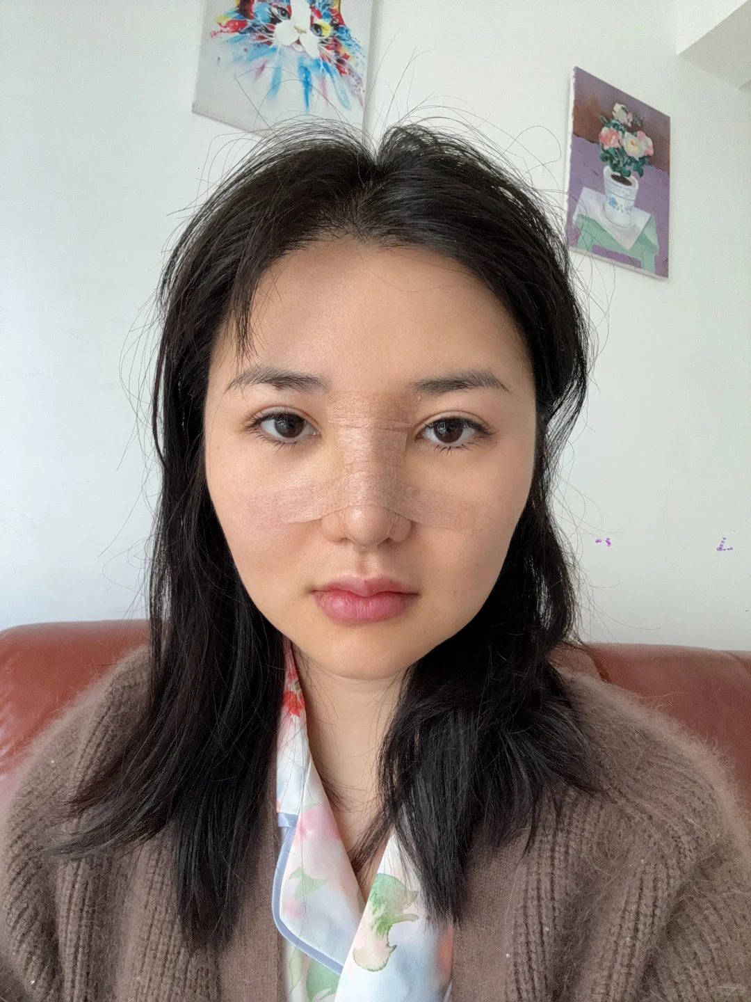 来长沙做鼻子了 手术完成后续