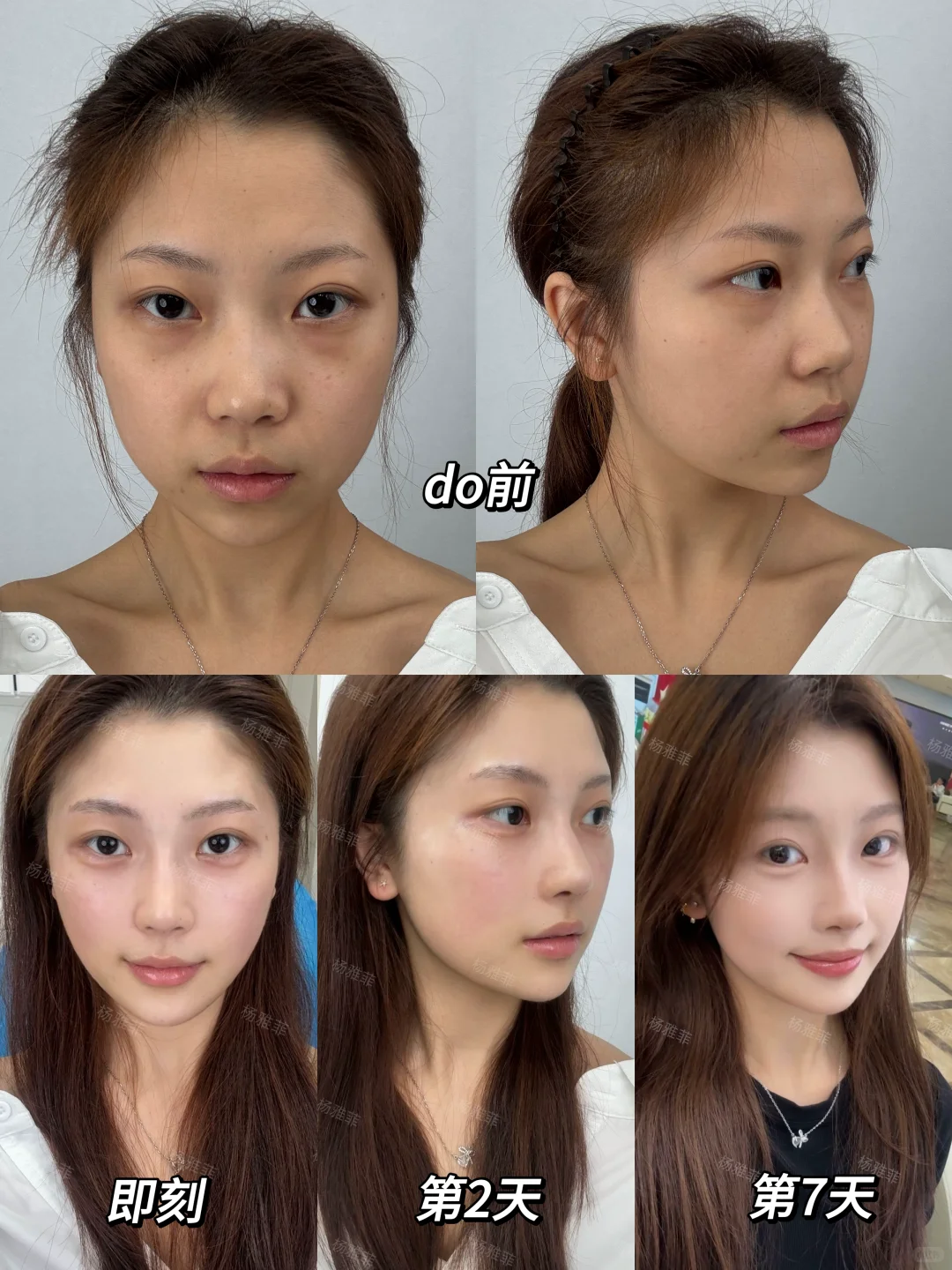 普通人打完啵啵1周变化，上岸了吗？