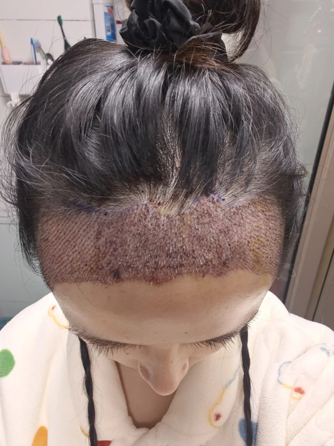 植发第三天