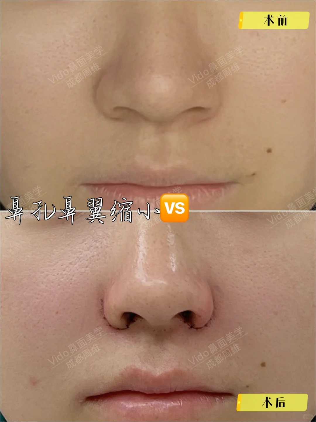 鼻孔鼻翼缩小🆚