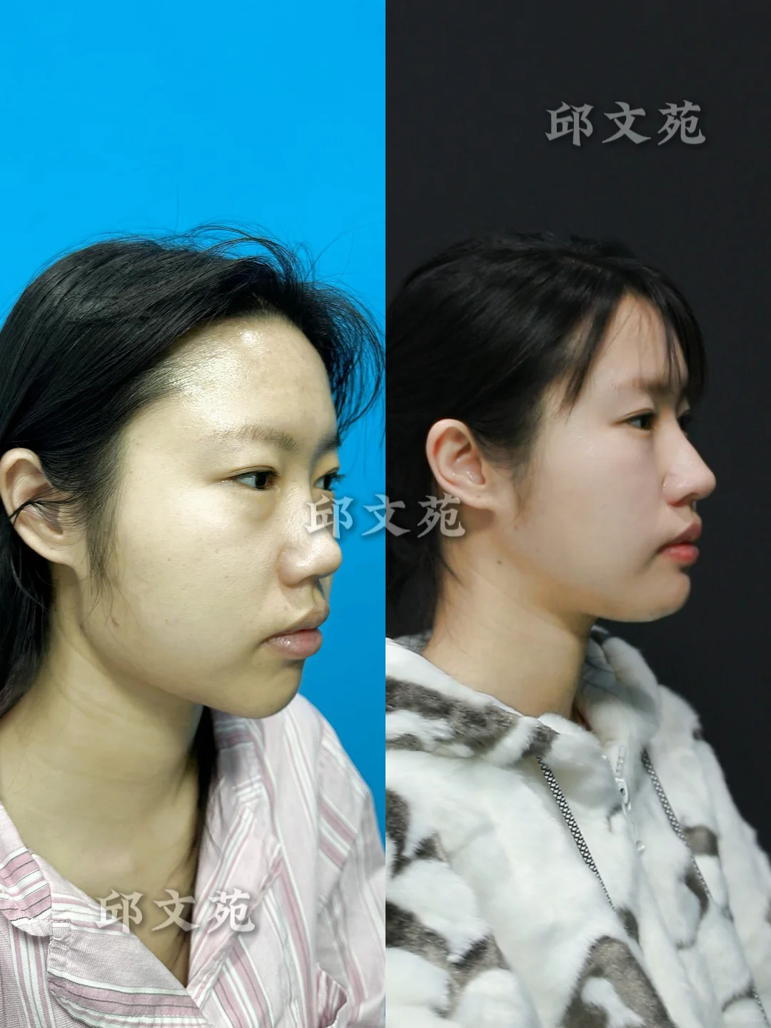 大鼻头修复丨妈生感直鼻微翘