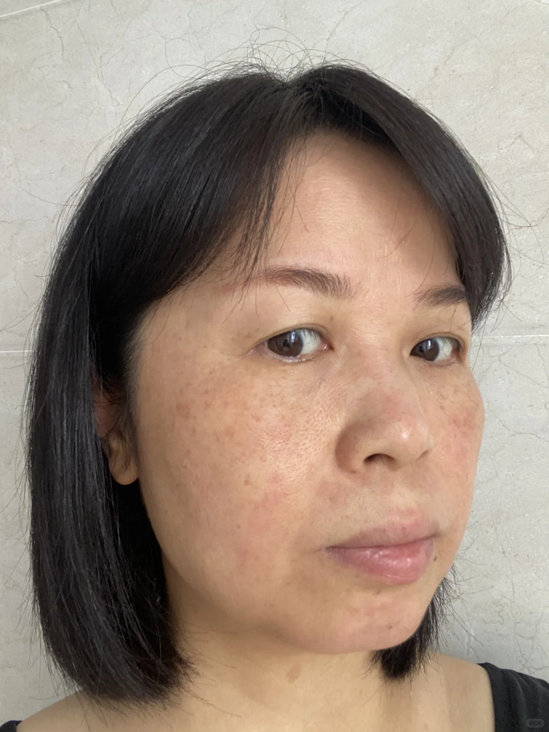 炎症排出来了！我真的没整容！