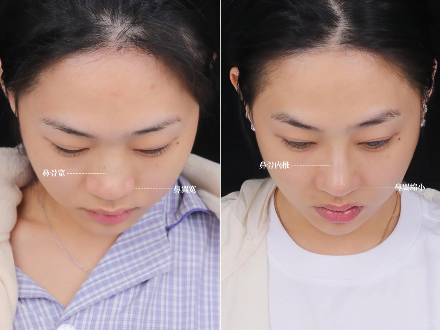 深圳do鼻|宽鼻+鼻基底凹陷
